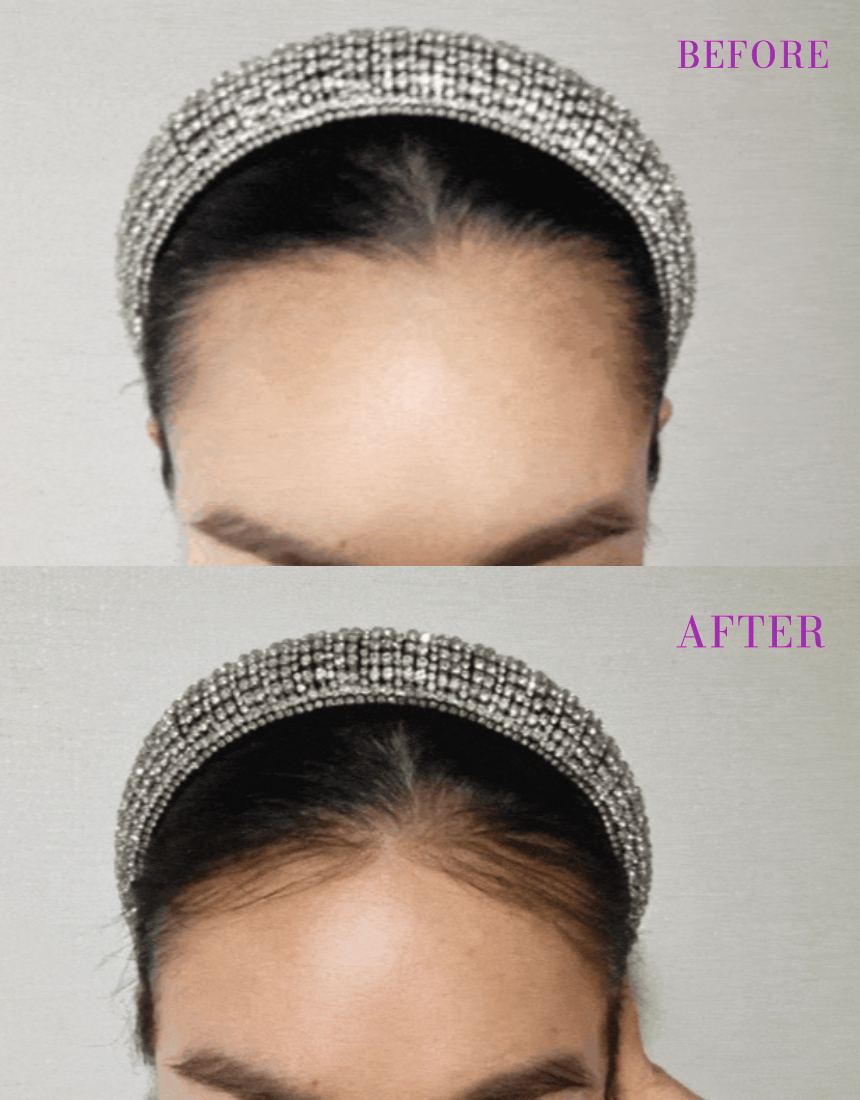 EdgeBabyHair™ - Natural Hairline Patch, Baby Hair Extensions for a Fuller Forehead (Hairline & Edges)
