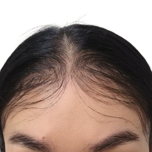 Natural Hairline Patch – No Black Dots, No Lace Shine