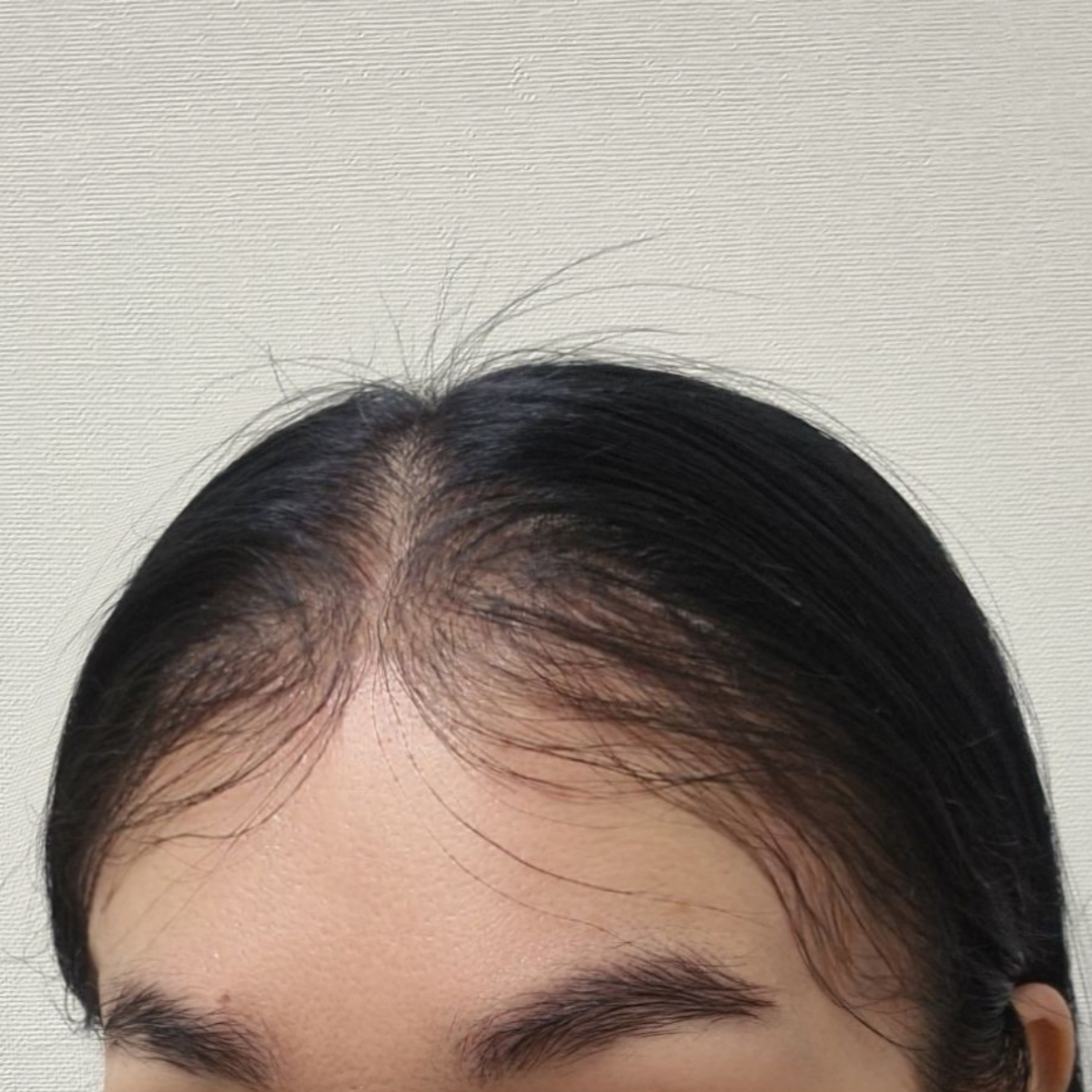 Natural Hairline Patch – No Black Dots, No Lace Shine